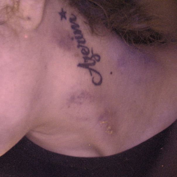 Bite marks and suction ecchymosis with flourescence on the left upper side of neck captured under D1 filter