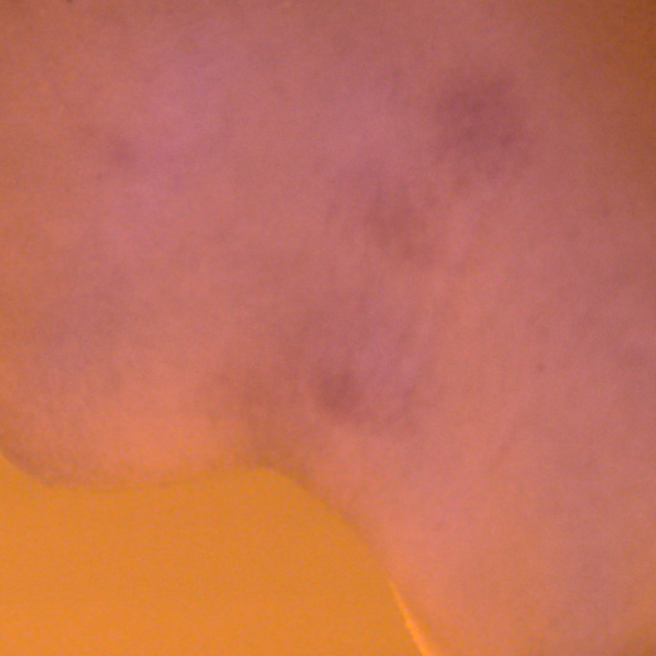 Figure 2: Bite marks under the left side of chin, captured under D2 filter of SAFE (Sexual Assault Forensic Examination) Imaging Systems