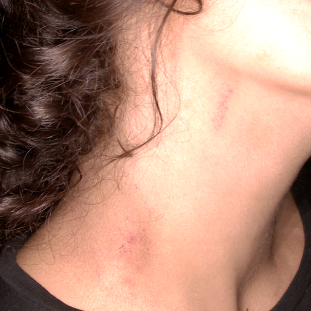 Suction ecchymosis and abrasions on the right side of neck, captured under white light of SAFE (Sexual Assault Forensic Examination) Imaging Systems