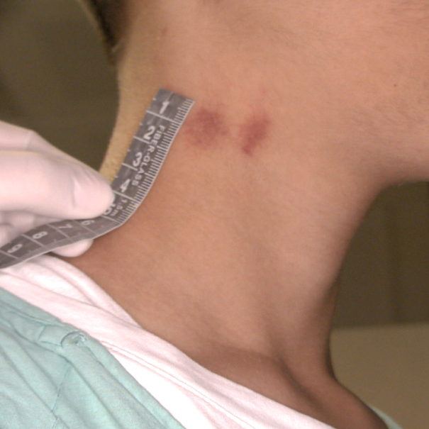 Figure 4: Suction ecchymosis on the right side of neck, captured under white polarized light of SAFE (Sexual Assault Forensic Examination) Imaging Systems