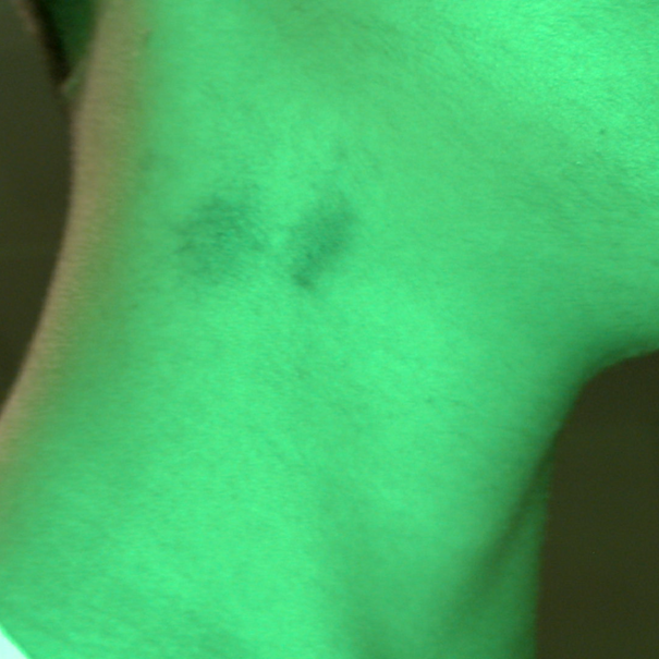 Figure 3: Suction ecchymosis on the right upper side of neck, captured under green light filter of SAFE (Sexual Assault Forensic Examination) Imaging Systems