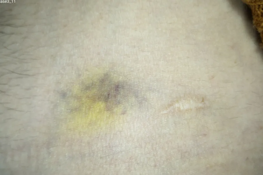 Visible-light close view of bruising on skin before enhanced forensic imaging with SAFE Pro 3.