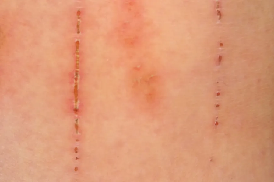 Nail marks and scratches on skin enhanced using a selected SAFE Pro 3 forensic imaging combination.