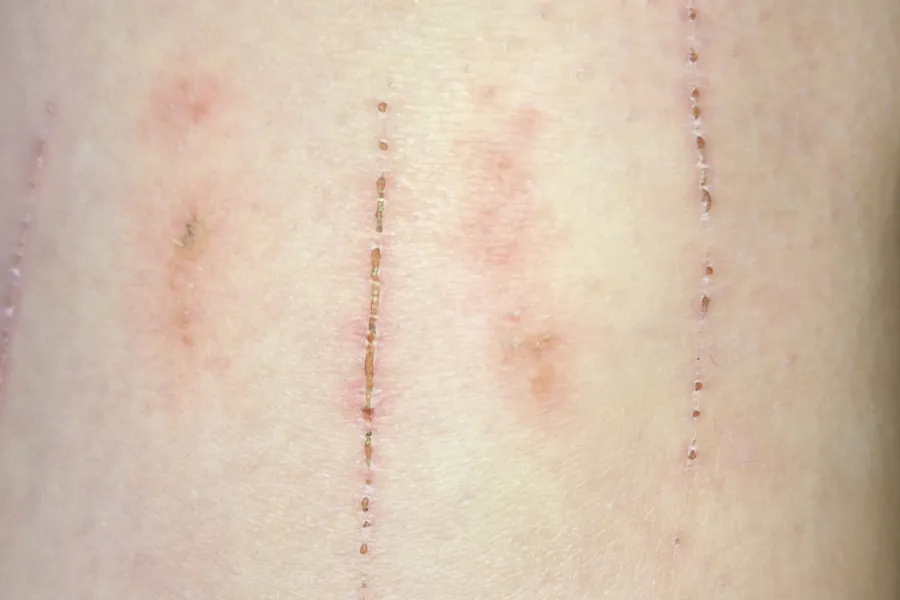 Visible-light view of linear nail marks and scratches on skin examined with SAFE Pro 3.