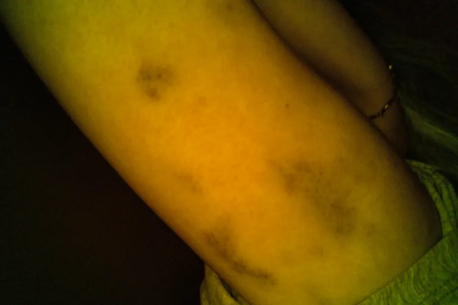 Bite mark on skin visualized with a selected SAFE Pro 3 illumination and filter combination.