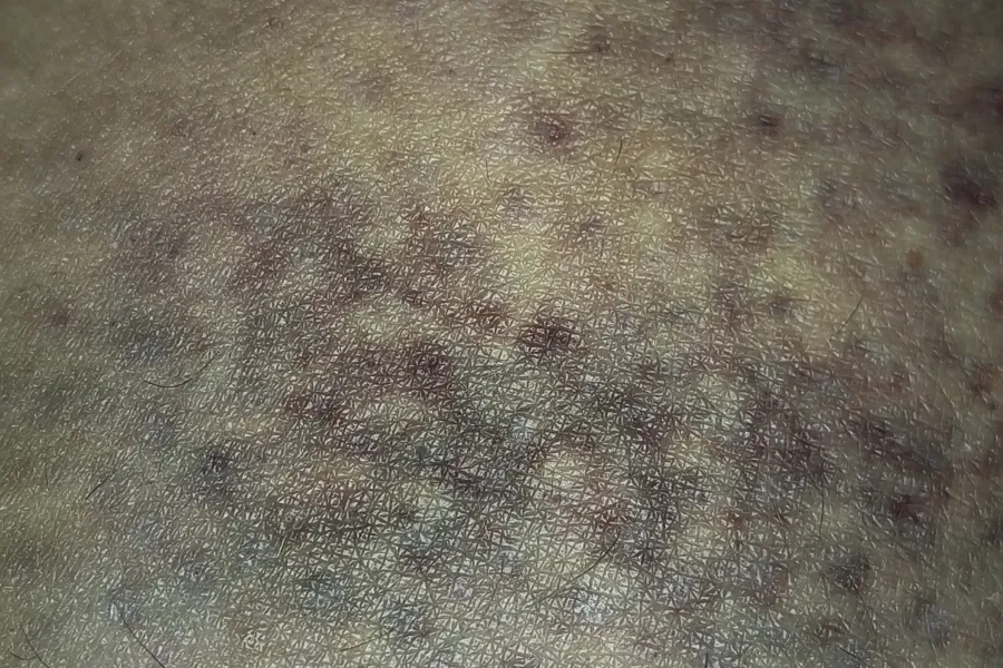 Visible-light close view of bruising on skin before enhanced forensic imaging with SAFE Pro 3.