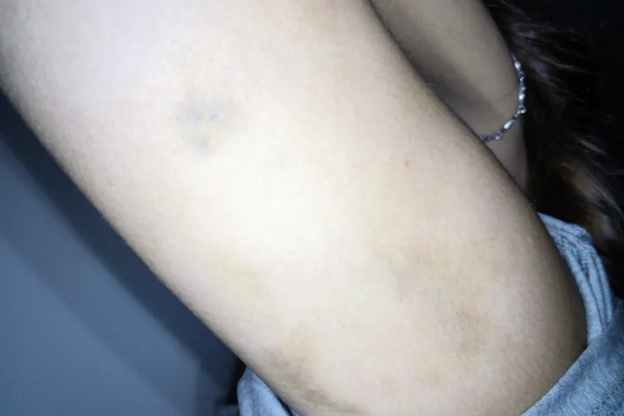 Visible-light view of a bite mark on skin examined with the SAFE Pro 3 forensic imaging system.